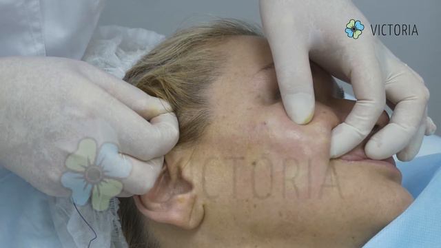 Установка двойной иглы в среднюю треть и PLLA в субментальную зону.