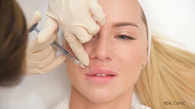 Увеличение губ Контурная пластика Juvederm смотреть онлайн