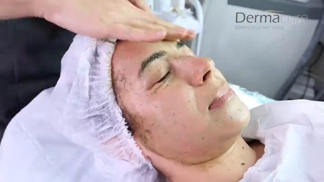 GREEN PEEL TREATMENT - BEST FOR PIGMENTATION AND SCARS | Dermacure Clinic смотреть онлайн