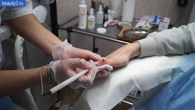 Удаление бородавок методом электрокоагуляция