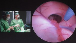 16Live Эндоскопия в нейрохирургии Тривентрикулоцистерностомия