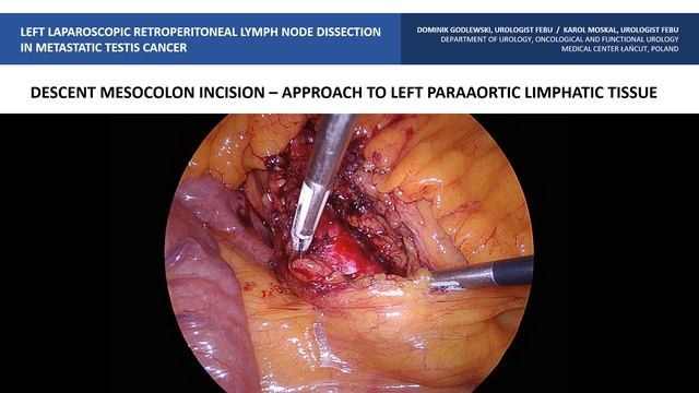 LEFT LAPAROSCOPIC RETROPERITONEAL LYMPH NODE DISSECTION VIDEO смотреть онлайн