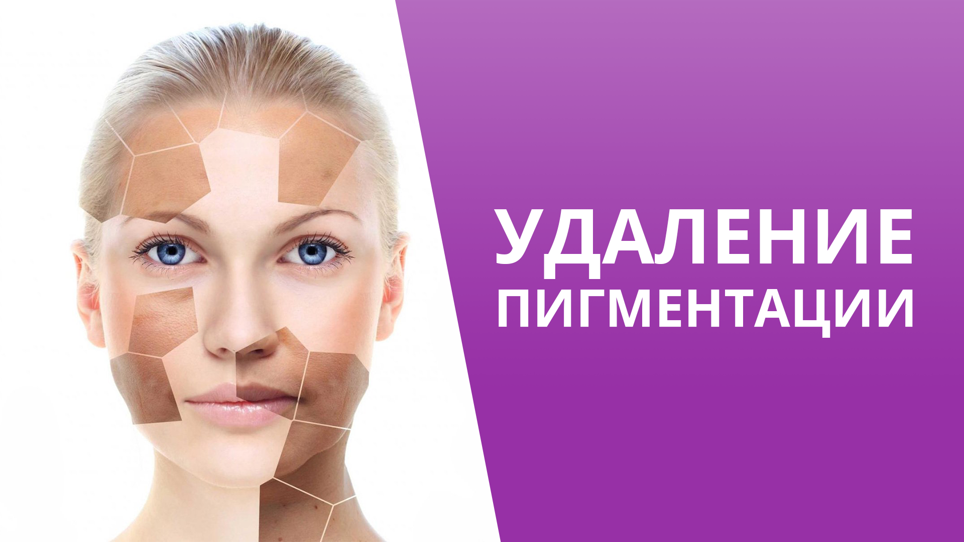 BBL против пигментации