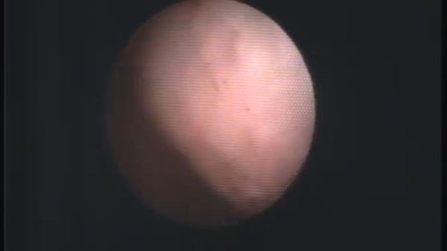 Эндометрий в постменопаузе на фоне приёма тамоксифена. Череповец смотреть онлайн