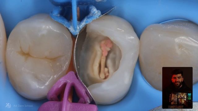 Поддесневые дефекты. Выпуск 3. aikdent.school смотреть онлайн