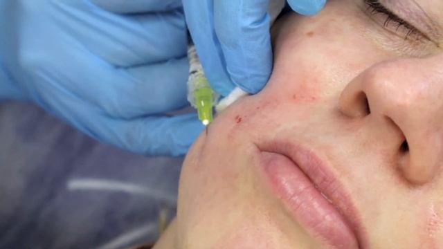 Коррекция мелких морщин в носогубных складках методом Blanch Technique смотреть онлайн