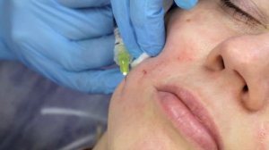 Коррекция мелких морщин в носогубных складках методом Blanch Technique