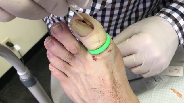 Ingrown Nail Permanent Removed With Acid