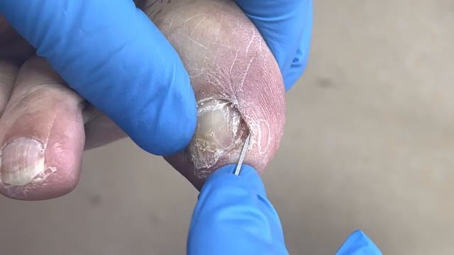 Dig out the yellow fungus on your toenails!【Pedicure Master Lin Jun】 смотреть онлайн
