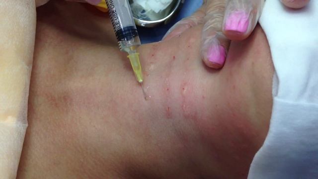 Мезотерапия Обучение Шея Морщины Ожерелья смотреть онлайн