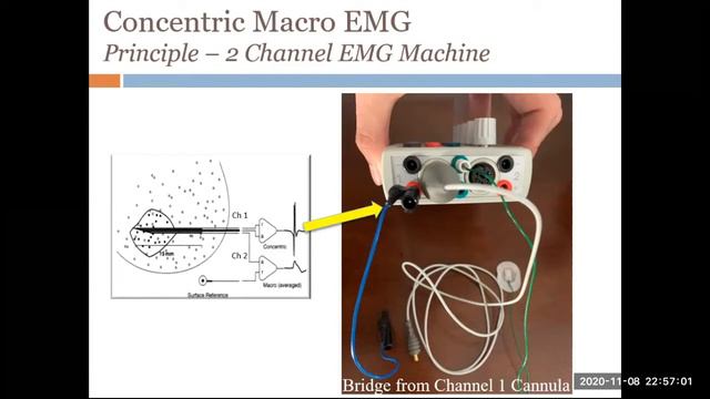 Макро-ЭМГ концентрическими электродами. /Concentric Macro-EMG: Modern Features Of EMG In Myopathies
