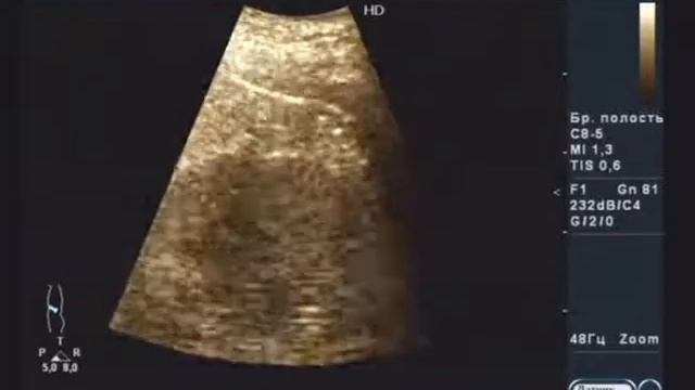 Осложненная киста почки с перегородками и кальцинатами смотреть онлайн