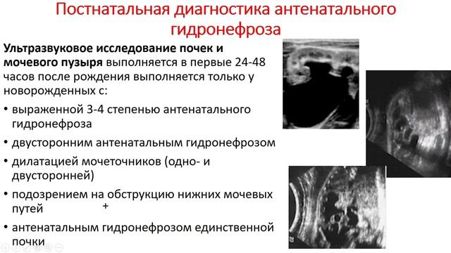 Урология. Лекция 7. Гидронефроз. Гидронефротическая трансформация почек смотреть онлайн