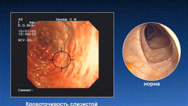 Воспалительные заболеваня толстой кишки_cron-diagnosis