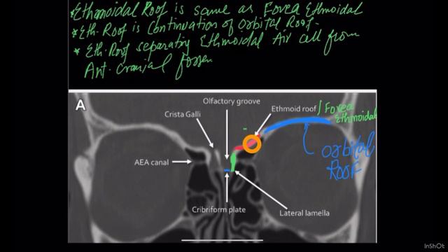 tkr ana 13 SKULL BONE ANATOMY AT THE LEVEL OF ORBIT смотреть онлайн