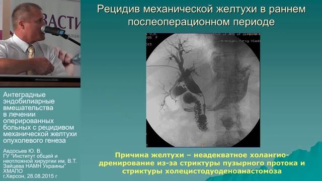 1633 Авдосьев Ю В Антеградные эндобилиарные вмешательства смотреть онлайн