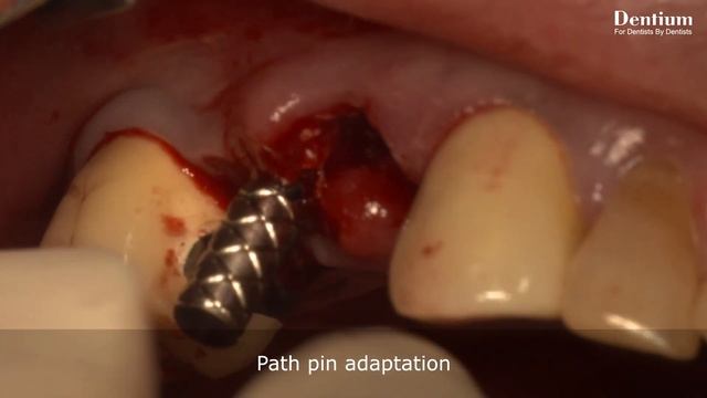 Sinus lifting with simple GBR using Osteotome (Prof. Soo-Hwan Byun commentary) смотреть онлайн