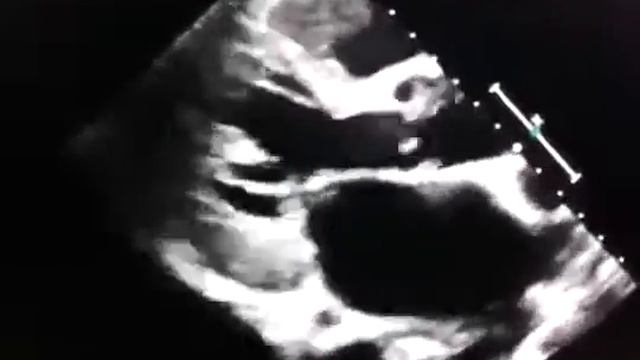 Эндокардит- 2 смотреть онлайн
