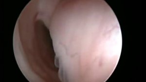 Гистероскопия.