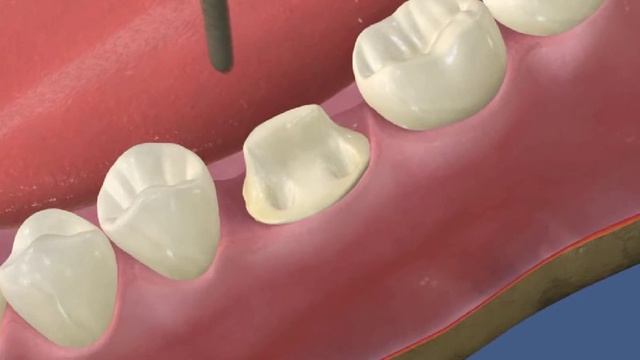 Коронки и мосты Культевая вкладка и последующая коронка на 36 смотреть онлайн