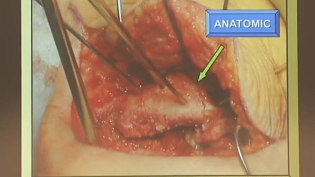 How to Fix a Displaced Intra Articular Calcaneus Fracture смотреть онлайн