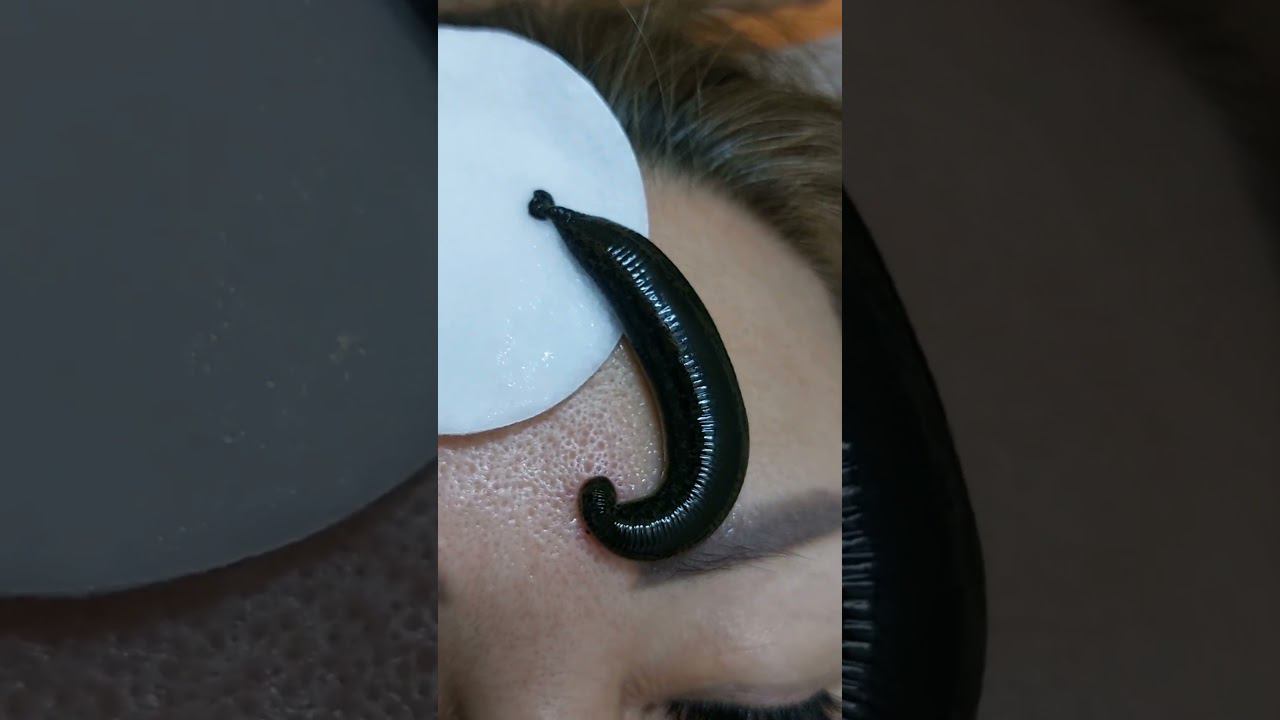 РАБОТА С ПИЯВКАМИ. ОБУЧЕНИЕ. #пиявки #гирудотерапия #лечениепиявками смотреть онлайн