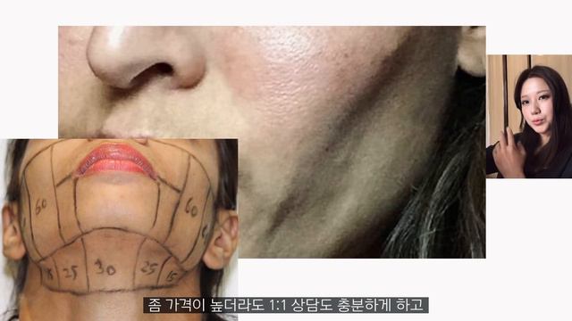 🌏CC) 리프팅 시술과 얼굴 뼈 축소에 관한 고찰, the bones of the face get old?! смотреть онлайн