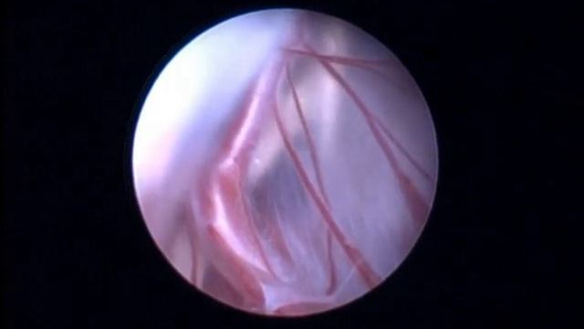 супраселлярная киста, нейроэндоскопия (SUPRASELLAR CYST) смотреть онлайн