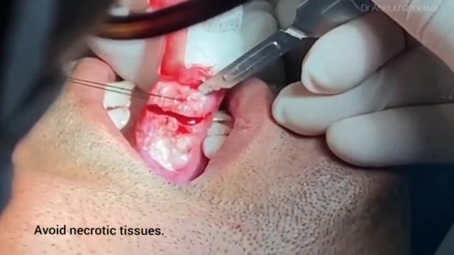 Incisional/Wedge Biopsy for a suspected case of Oral/Tongue Cancer by Dr Ankit Khandelwal смотреть онлайн