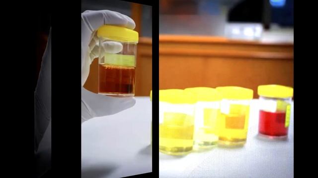 5 малозаметных симптомов рака поджелудочной железы, которые люди часто упускают смотреть онлайн