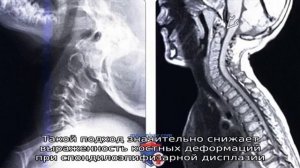 Спондилоэпифизарная дисплазия