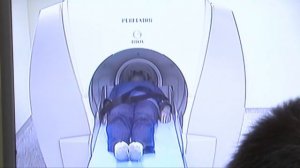 Гамма-нож останавливает опухоль мозга