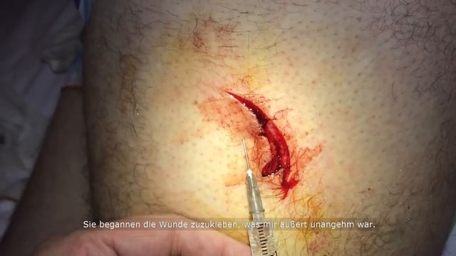 Shark Attack In The Red Sea (Egypt)-Shark-Attack