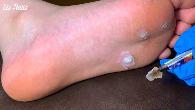 Стержневая мозоль удаление I как удалить МОЗОЛЬ в домашних условиях Calluses, Plantar Warts, Corn смотреть онлайн