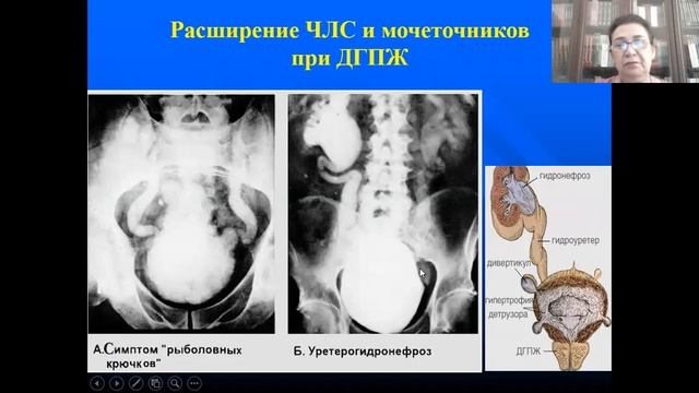 Доброкачественная гиперплазия предстательной железы