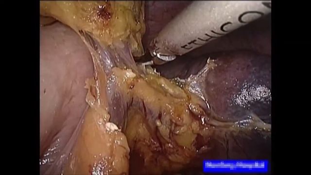 Asvide: Laparoscopic total gastrectomy with spleen-preserving splenic hilar (No. 10) lymph nodes... смотреть онлайн