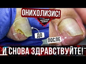 СНОВА ОН! ОНИХОЛИЗИС ногтей на большом пальце? Причины онихолизиса? Онихолизис Большого Ногтя??
