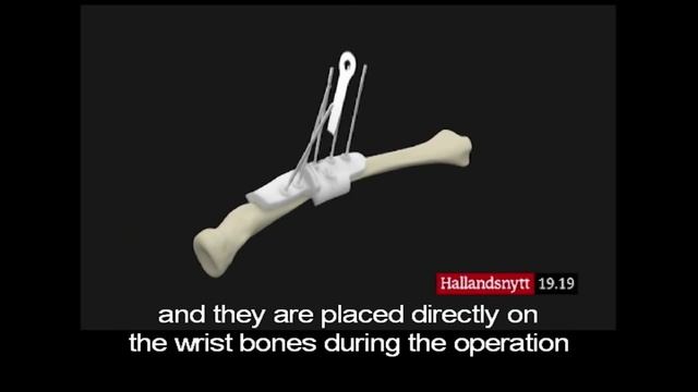 First Swedish case using Materialise's patient-specific surgical guides and 3D planning смотреть онлайн