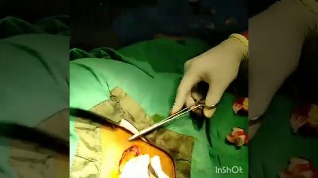 Large mole excision... Under local anaesthesia#mole #largemole #blackmole смотреть онлайн