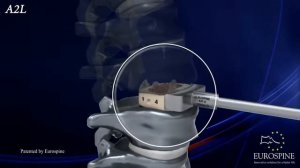 HRC™ ALIF A2L Стабилизирующий поясничный кейдж для передней установки с двумя фиксирующими лезвиями
