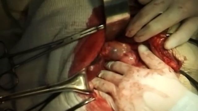 Холедохоэктазия.Холедохолитиаз.Choledochoectasia. Choledocholithiasis. смотреть онлайн