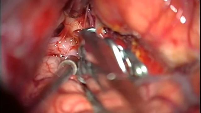 Surgical treatment of multiple saccular aneurysms смотреть онлайн
