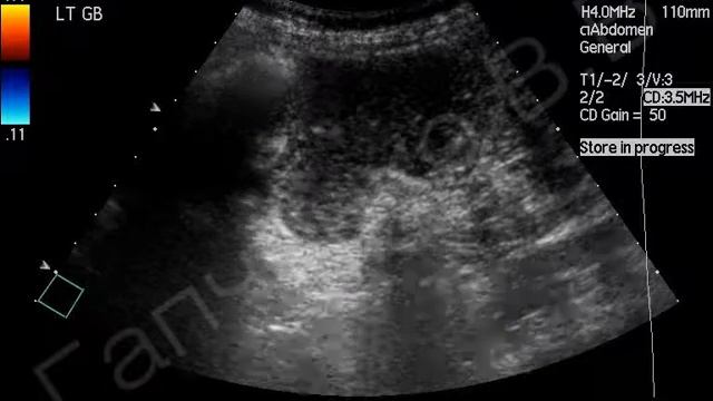 УЗИ толстого кишечника с контрастированием смотреть онлайн