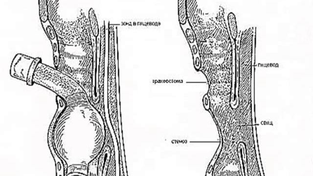 Деканюляция трахеостомированного пациента А.С.Горячев смотреть онлайн