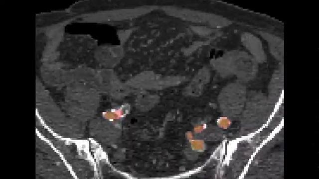 Automatic aortic segmentation from CTA using Deep Learning смотреть онлайн