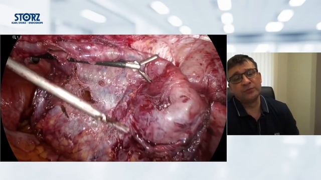 еТЕР пластика вентральных грыж, 2 часть. Задняя сепарационная пластика смотреть онлайн