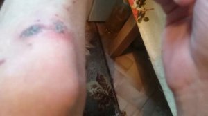 Лучшее заживление раны....