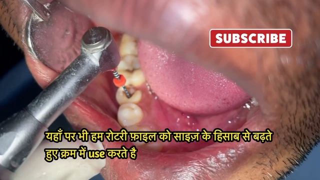How Root canal treatment / RCT is done ? Know both Manual and Rotary system смотреть онлайн