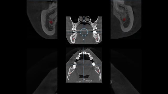 Какой зуб на кт ? Вопрос для студентов ✔️ смотреть онлайн
