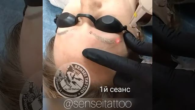 ВЫВЕДЕНИЕ ЛАЗЕРОМ НЕКАЧЕСТВЕННОГО ТАТУАЖА БРОВЕЙ И СТРЕЛОК смотреть онлайн